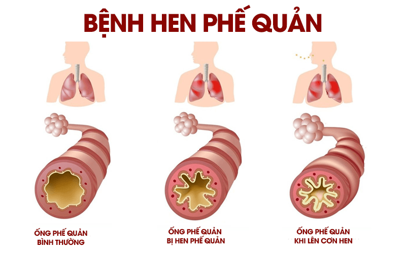 hen-phe-quan-1