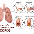 Bệnh phổi tắc nghẽn mãn tính (COPD) có 2 dạng