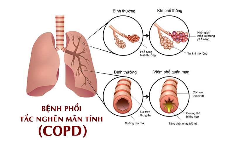 Bệnh phổi tắc nghẽn mãn tính (COPD) có 2 dạng