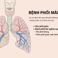Bệnh phổi mạn tính là các căn bệnh liện quan đến phổi, đường hô hấp kéo dài trên 3 tháng trở lên và có thể là vĩnh viễn