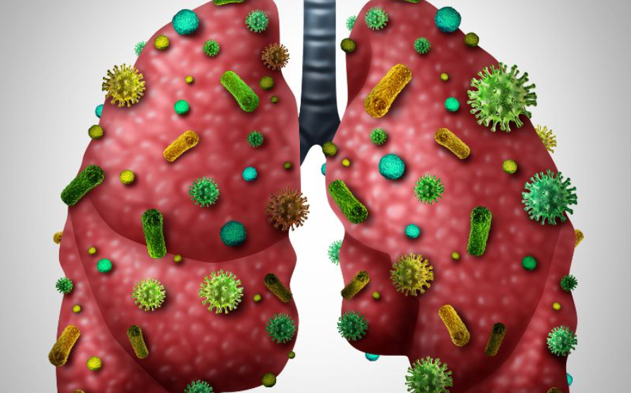 Viêm phổi có thể do nhiễm vi khuẩn, virus, nấm hoặc hít phải hóa chất độc hại