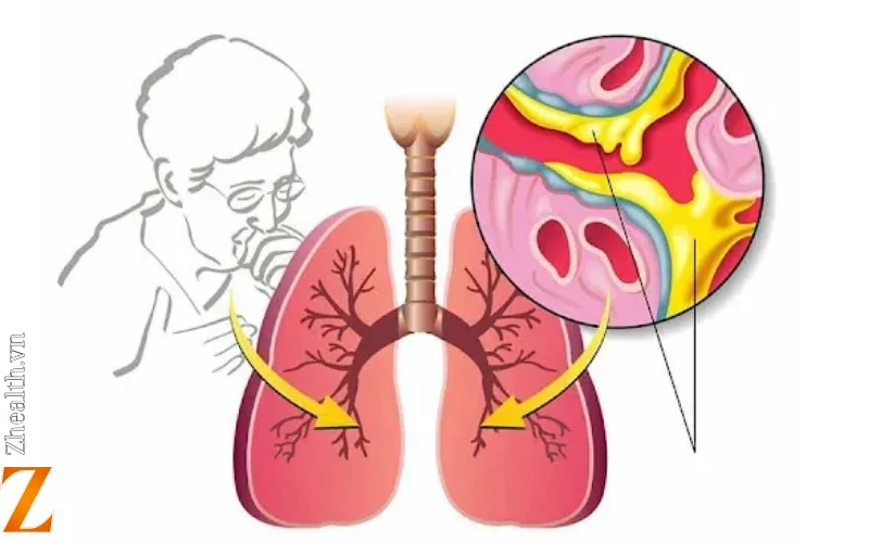 Tại sao đờm lại mắc ở cổ họng gây khó chịu?