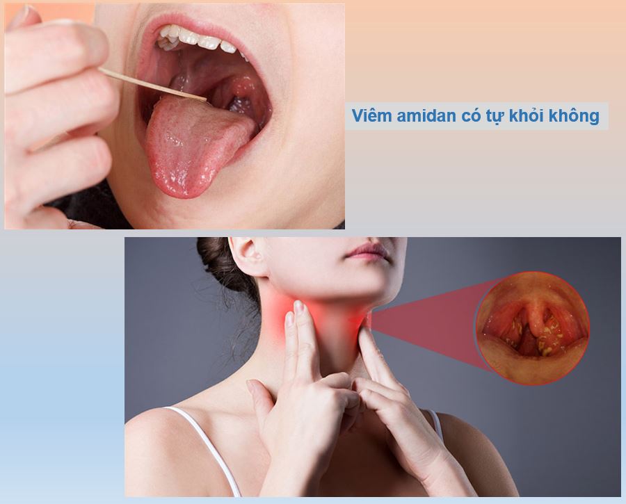 Phát hiện dấu hiệu viêm amidan sớm, cổ họng vẫn có khả năng tự khỏi