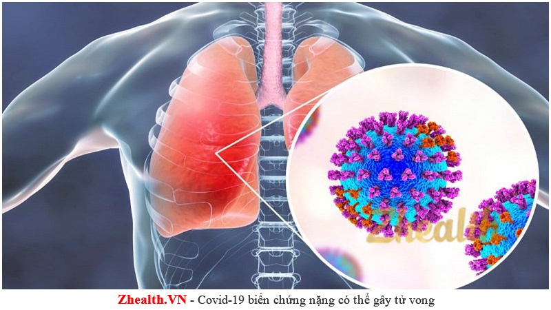 Bệnh Covid-19 nếu biến chứng nặng có thể gây tổn thương phổi, hệ thần kinh thậm chí là tử vong