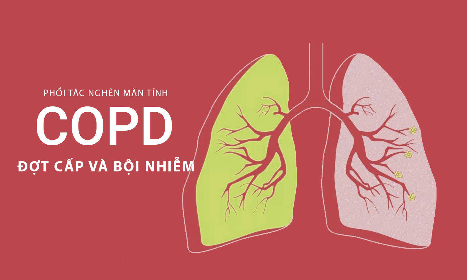 Ảnh: Đợt cấp COPD và COPD bội nhiễm là gì? 