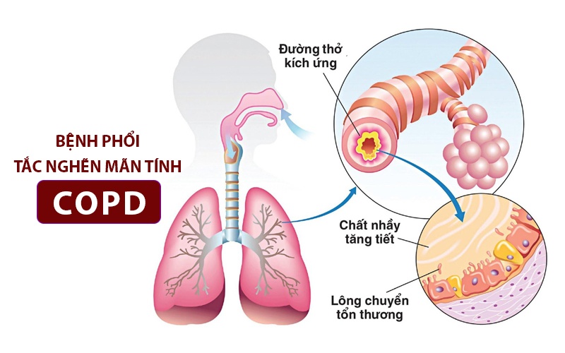 Ảnh: Bệnh viêm phổi tắc nghẽn COPD 