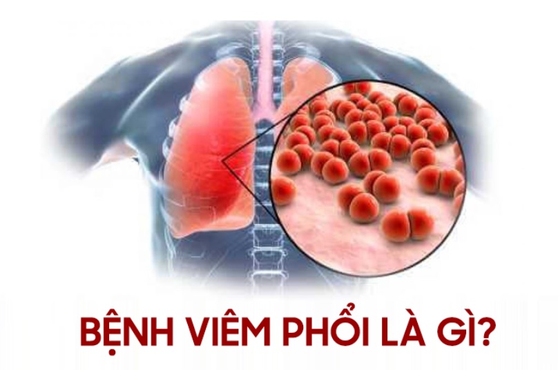 Viêm phổi là bệnh lý nghiêm trọng có thể gây ra các biến chứng nguy hiểm