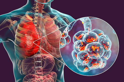 Viêm phổi xuất hiện khi phổi bị các loại virus, nấm, hoặc vi khuẩn tấn công