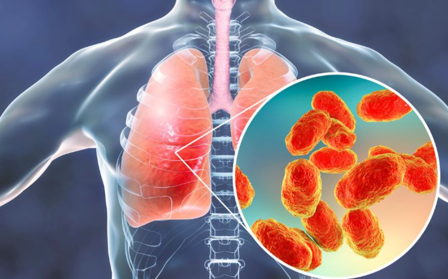 Bệnh viêm phổi gây viêm nhiễm ở các túi khí gây khó hô hấp