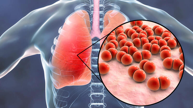 Viêm phổi kẽ là một bệnh lý khó điều trị và dễ để lại di chứng